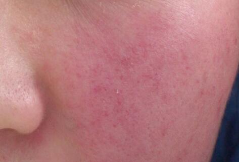 如何拯救你的敏感肌？廣西南寧美容培訓(xùn)叫你正確方法