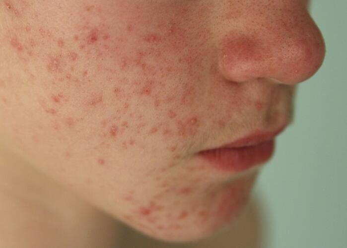 粉刺閉口應(yīng)該如何處理？