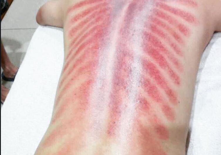 美容：不同刮痧顏色代表的癥狀