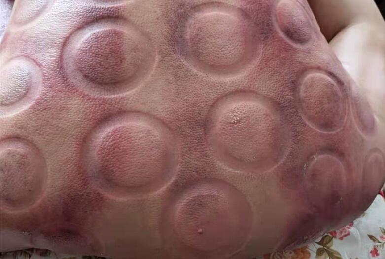 怎樣拔火罐？南寧美容學(xué)校手把手教你