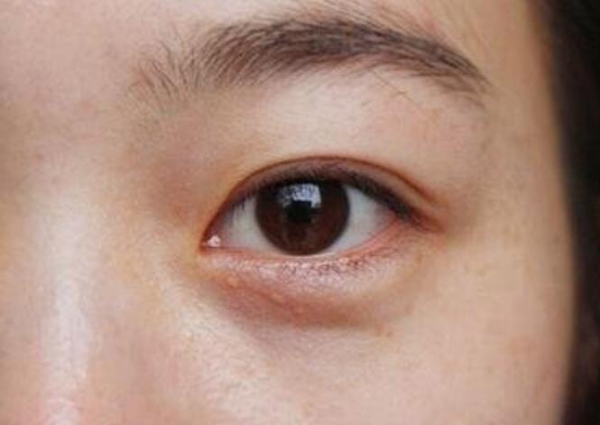 黑眼圈的種類有哪些？廣西美容培訓(xùn)教你保養(yǎng)