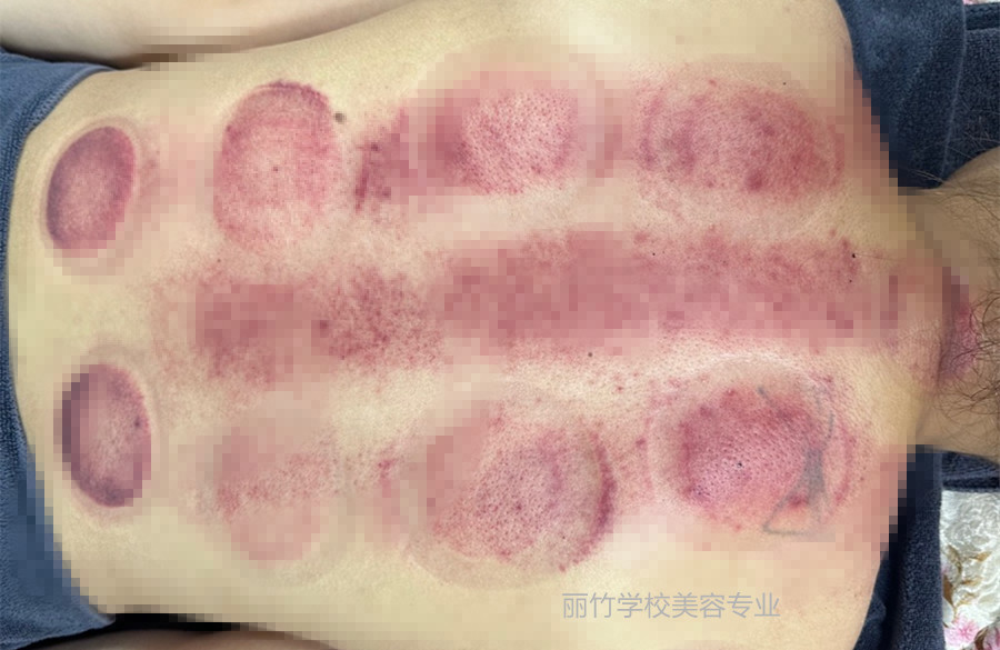 拔火罐的顏色代表什么？南寧美容美體專業(yè)實訓(xùn)
