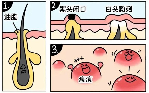 不同部位閉口形成的原因，南寧美容護(hù)膚學(xué)校解答