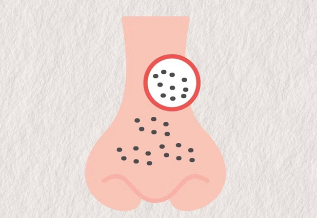 廣西皮膚管理師：面對嚴(yán)重的黑頭應(yīng)該怎么辦？